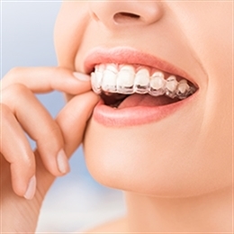 Clear Aligners​​ - Alineadores Invisibles ​ Jupiter Florida