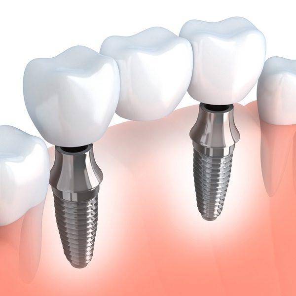 Dental Implants​ - Implantes dentales Florida Jupiter